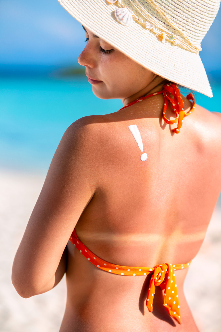 Tanned young woman in bikini showing exclamation point on shoulder due to sunburn,  tan line and reddish skin